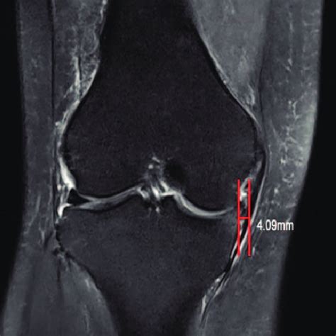 Pdf Effect Of Medial Meniscus Extrusion On Arthroscopic Surgery