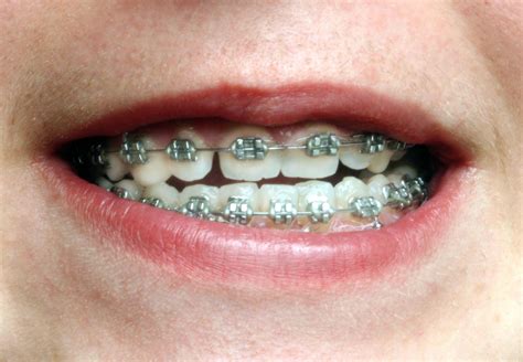 Why Diy Braces Are Actually A Terrible Terrible Idea The Washington Post