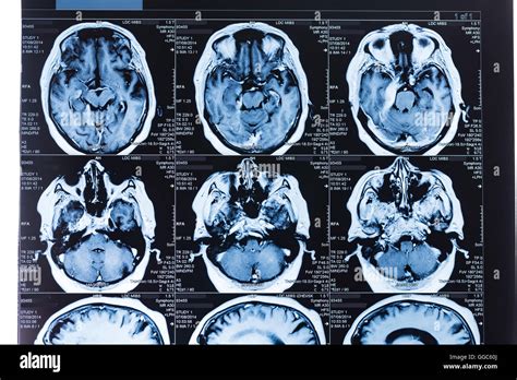 Mri Scan Hi Res Stock Photography And Images Alamy