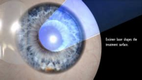 Z Lasik Femtosekundový laser iClinic očná klinika Bratislava