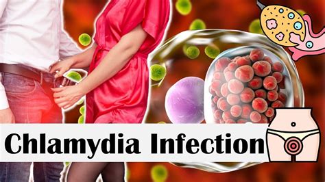 Chlamydia Infection Causes Risk Factors Transmission Signs