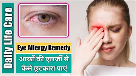 How To Relieve Itchy Eyes From Allergies
