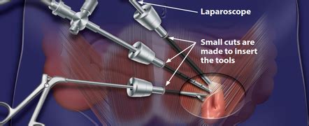 One way to gauge whether you are ready to drive is to determine if you can safely and quickly react to an unexpected. How long does it take to recover after a laparoscopic ...