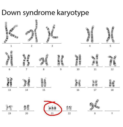 Down Syndrome Karyotype Medizzy
