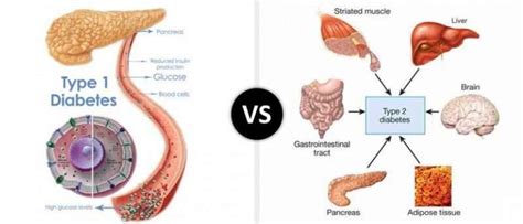Type 1 diabetes is an autoimmune condition in which your body's own immune system attacks the cells in your pancreas that make insulin. Differences Between Type 1 and Type 2 Diabetes ...