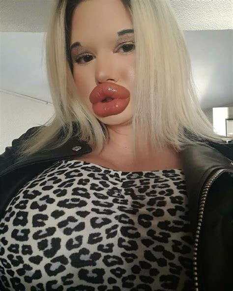 News And Report Daily Im Addicted To My Big Lips Doctors Say I