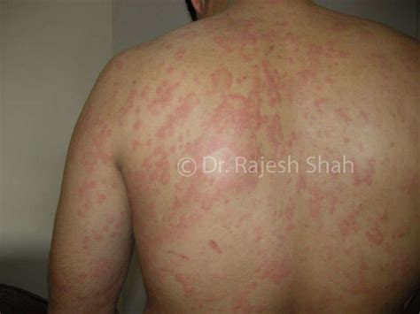 Urticaria Guide For Patients I Causes And Homeopathy Treatment