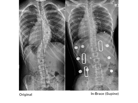 Spinal Technology Providence Nocturnal Scoliosis Orthosis