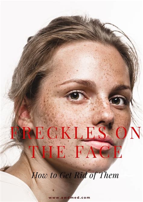 Freckles On The Face Why They Appear And How To Get Rid Of Them