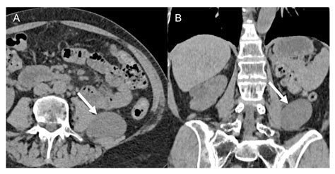 Cancers Free Full Text Ct And Mr Imaging Of Retroperitoneal