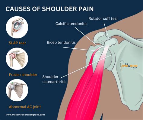 How To Resolve Right Neck And Shoulder Pain The Spine Rehab Group