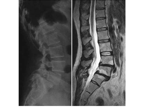 L4l5 And L5s1 Spondylolisthesis In A 45 Year Old Woman Download