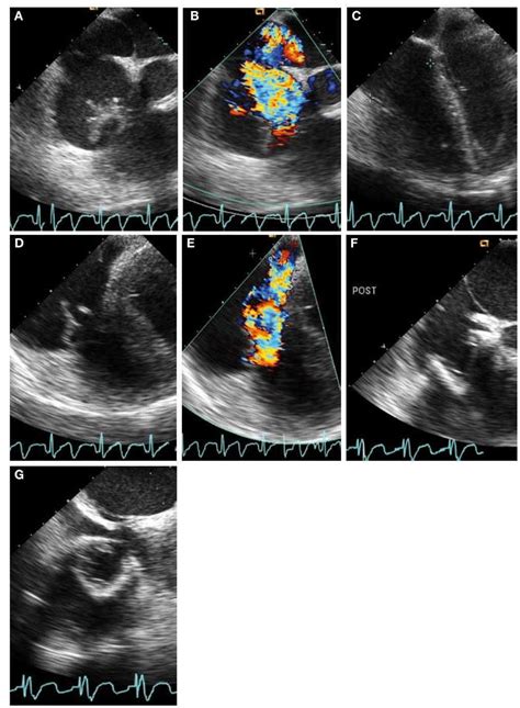 Tricuspid And Pulmonary Valve Disease Evaluation And Management