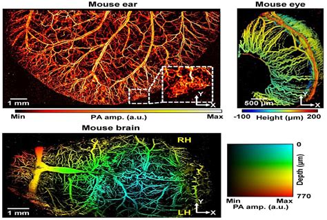 Super Resolution Photoacoustic Microscopy Finds Clogged Blood Vessels