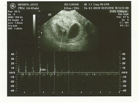 Two For One Special 8 Week Ultrasound Pictures