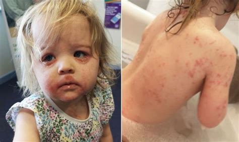 Eczema Cream Miracle Treatment Helped Cure Babys Rash On Face