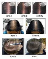 Images of Most Effective Treatment For Female Hair Loss