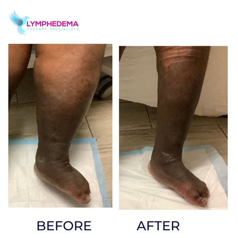 Before And After Lymphedema Therapy Specialists