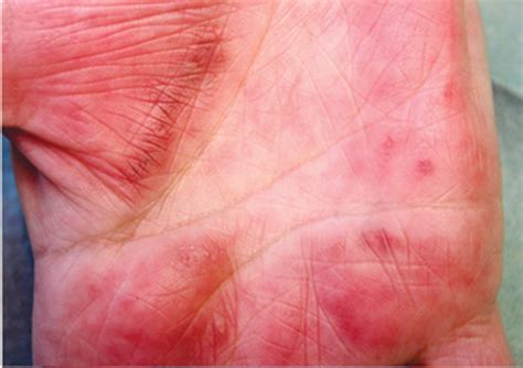 Images Of The Month 4 Cutaneous Amyloidosis A Clinical Challenge