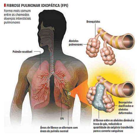 Fibrose Pulmonar O Que é Sintomas E Tratamento Viva Fisio