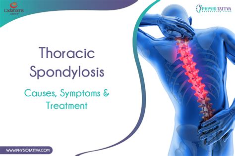 Thoracic Spondylosis Causes Symptoms And Treatment