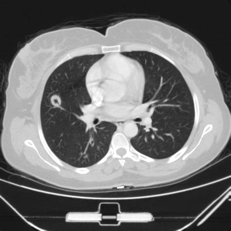 Pulmonary Manifestations Of Granulomatosis With Polyangiitis Pacs