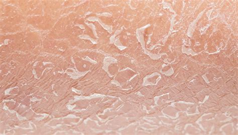 Abnormal Condition Of Dry Or Scaly Skin In Older Individuals