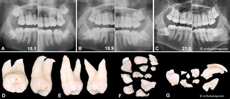 Evolution Of The Position Of Lower Wisdom Teeth During A 6 Year Period