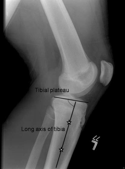 Fig1increased Medial Tibial Slope In Teenage Pediatric Population With