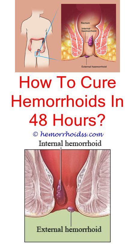 Some hemorrhoids can't be managed with conservative treatments alone, either because symptoms persist or because an internal hemorrhoid has prolapsed. Can You Workout With Hemorrhoids? | Bleeding hemorrhoids ...
