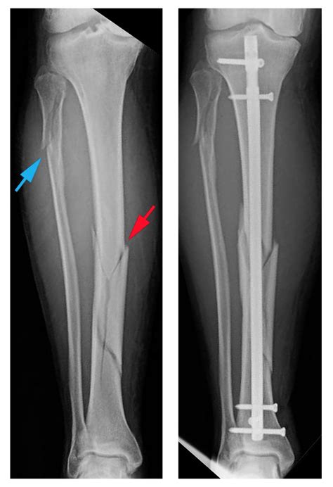 Tibia Shinbone Shaft Fractures Orthoinfo Aaos