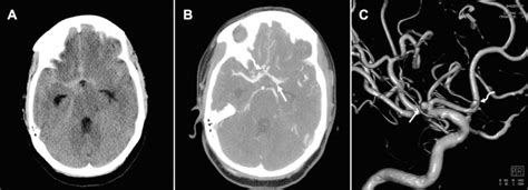 Clinical Images Vessel Wall Imaging In The Management Of Subarachnoid