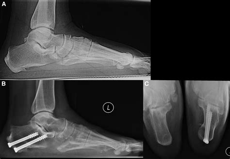 Percutaneous Posterior Calcaneal Osteotomy The Journal Of Foot And
