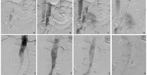 A D Angiography Of The Aorta And Inferior Vein Cava Demonstrated