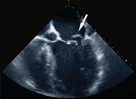 Transoesophageal Echo Images Showing Marked Posterior Mitral Valve