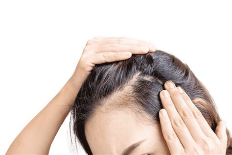 Female Hair Loss Treatment Singapore Terra Medical Clinic For Hair Loss