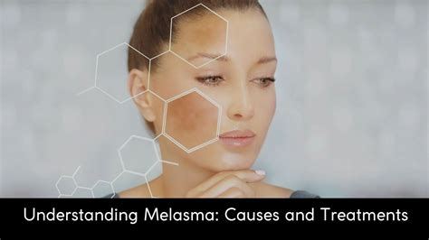 Understanding Melasma Causes And Treatments