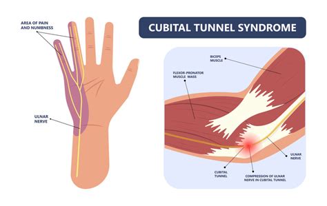 What Is Cubital Tunnel Syndrome Youssra Marjoua Md Baltimore Md