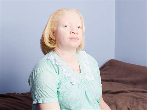 Albinism Beauty Magazine Things To Gush About