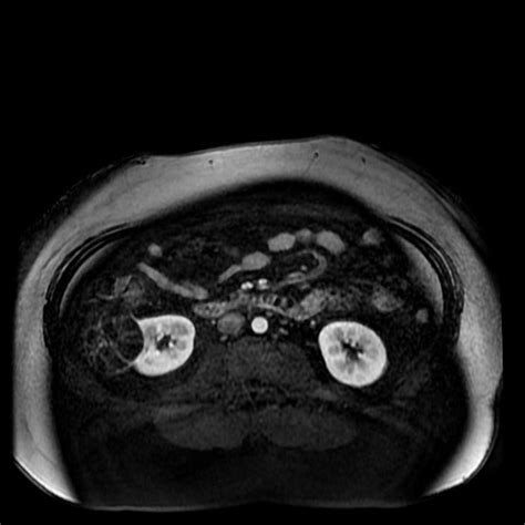 Multilocular Cystic Nephroma Of The Kidney Body Mr Case Studies