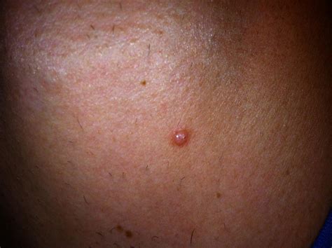 Skin Cancer Photos Early Stages