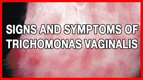 Signs And Symptoms Of Trichomonas Vaginalis Or Trich In Men And Women