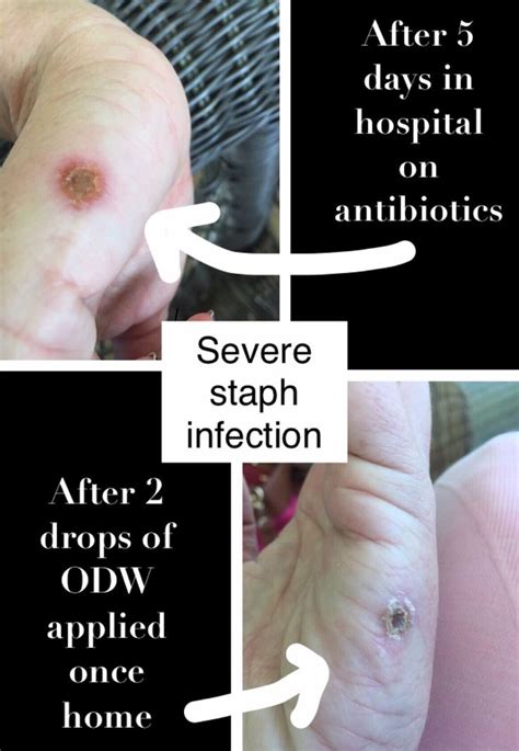 One Drop Wonder Used To Treat Staph Infection Staph Infection