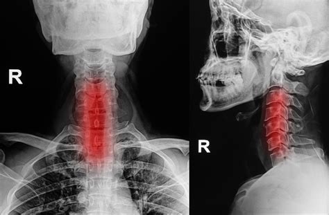 Reversal Of Cervical Lordosis Treatment Quotes Update Viral