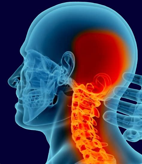 What Is The Treatment For Occipital Neuralgia
