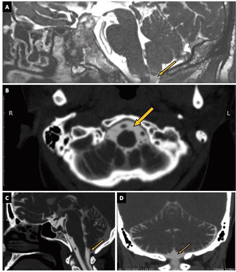 Cureus Delineation Of Subarachnoid Cisterns Using Ct Cisternography