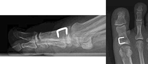 Radiographic Evaluation Of Isolated Continuous Compression Staples For