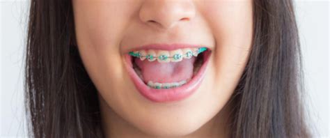How To Tell If Your Child Needs Braces