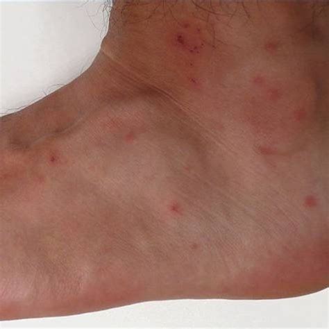 Chigger Bites On An Ankle Health First Aid Pinterest Chigger
