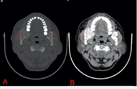 Axial Ct Bone Window A And Soft Tissue Window B The Images Show